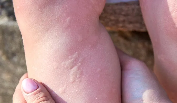 how to avoid cold urticaria